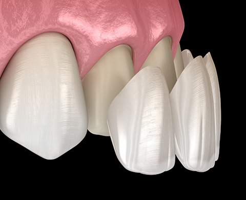 Illustration of veneers being placed over the upper teeth