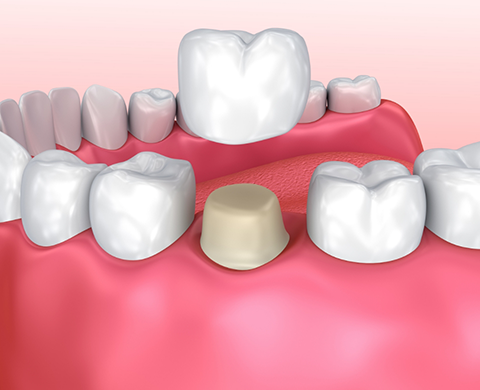 Illustrated dental crown being fitted over a tooth