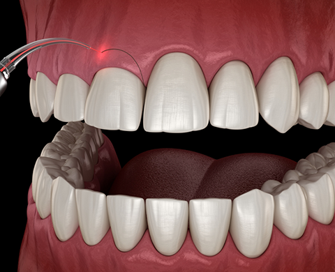 Illustration of dental laser treating a gummy smile