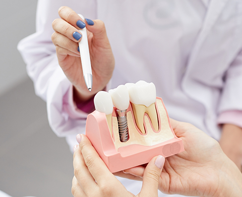 Dentist showing a model of a dental implant to a patient