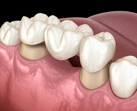 Illustrated dental bridge replacing a missing tooth