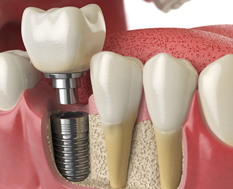 Illustrated dental implant replacing a missing tooth