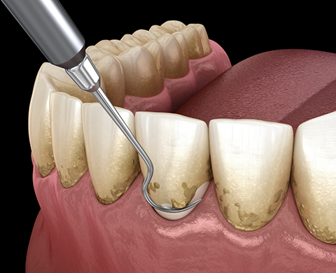 Illustrated dental scaler clearing plaque buildup from teeth