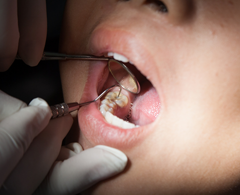 Close up of a patient receiving a dental exam