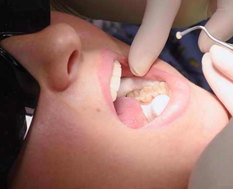 Close up of dental patient receiving a filling