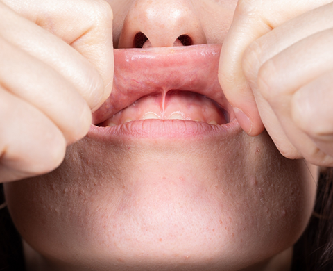 Close up of person lifting up and stretching their upper lip