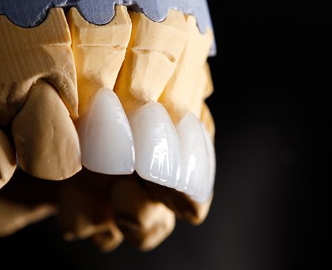 Dental veneers on model of teeth